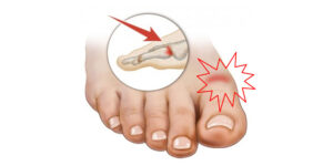 hallux limitus