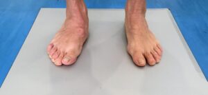 pies asimétricos