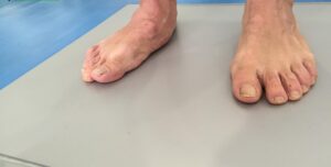pies asimétricos