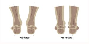 pie valgo