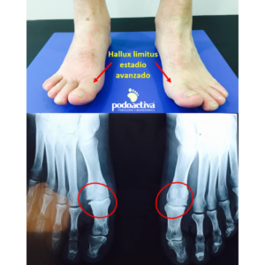 hallux limitus hallux rigidus