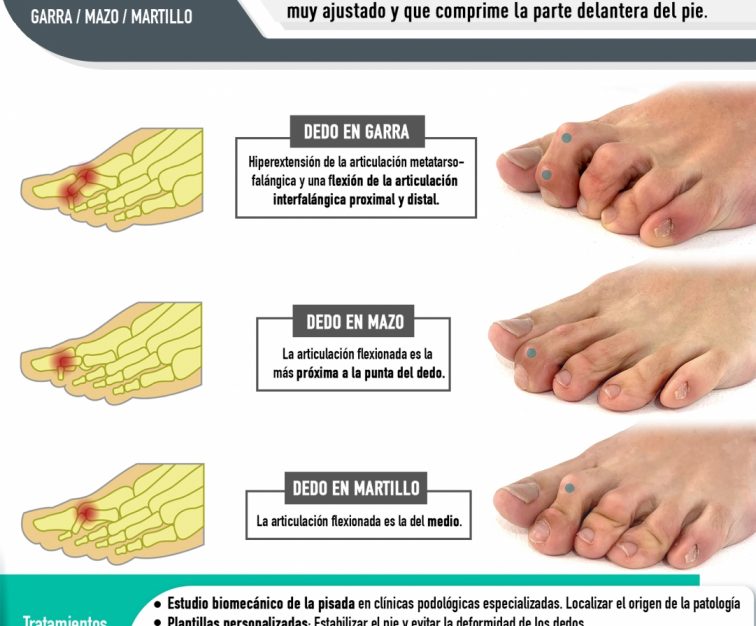 dedos_en_garra_mazo_y_martillo_0 dedos_en_garra_mazo_y_martillo_0